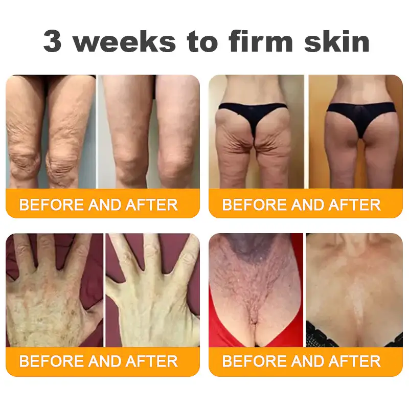 🔥 FLASH SALE! Extra 50% OFF 🔥 | Limited-Time Discount! TLOPA® Bee Venom Skin Restoration Cream🌞