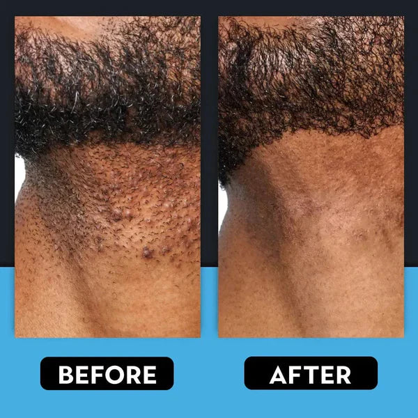 Razor Bump & Ingrown Hair Treatment