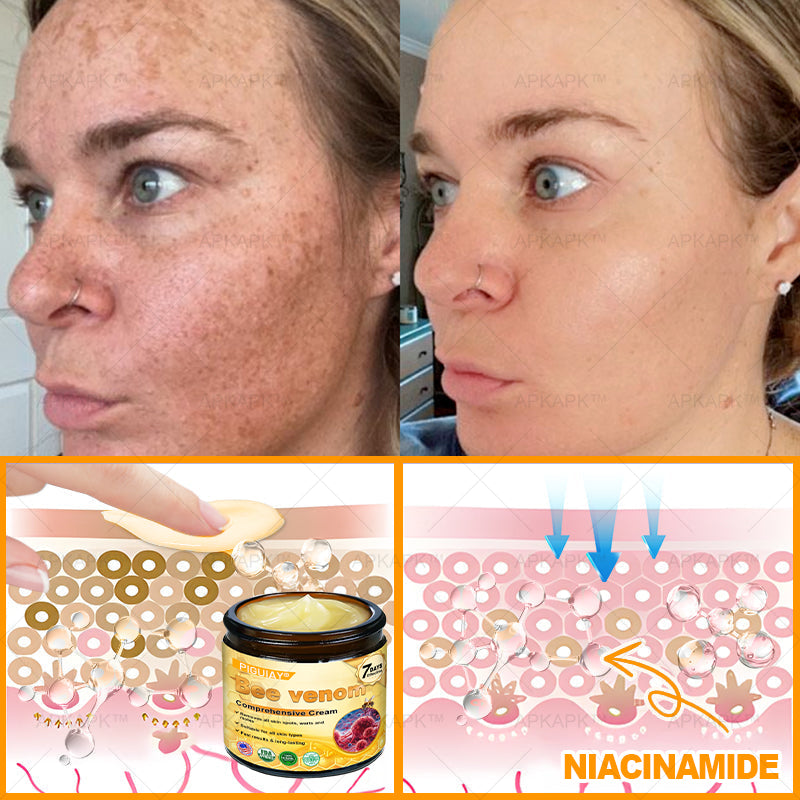 🔥 FLASH SALE! Extra 50% OFF 🔥 | Limited-Time Discount! TLOPA® Bee Venom Skin Restoration Cream🌞
