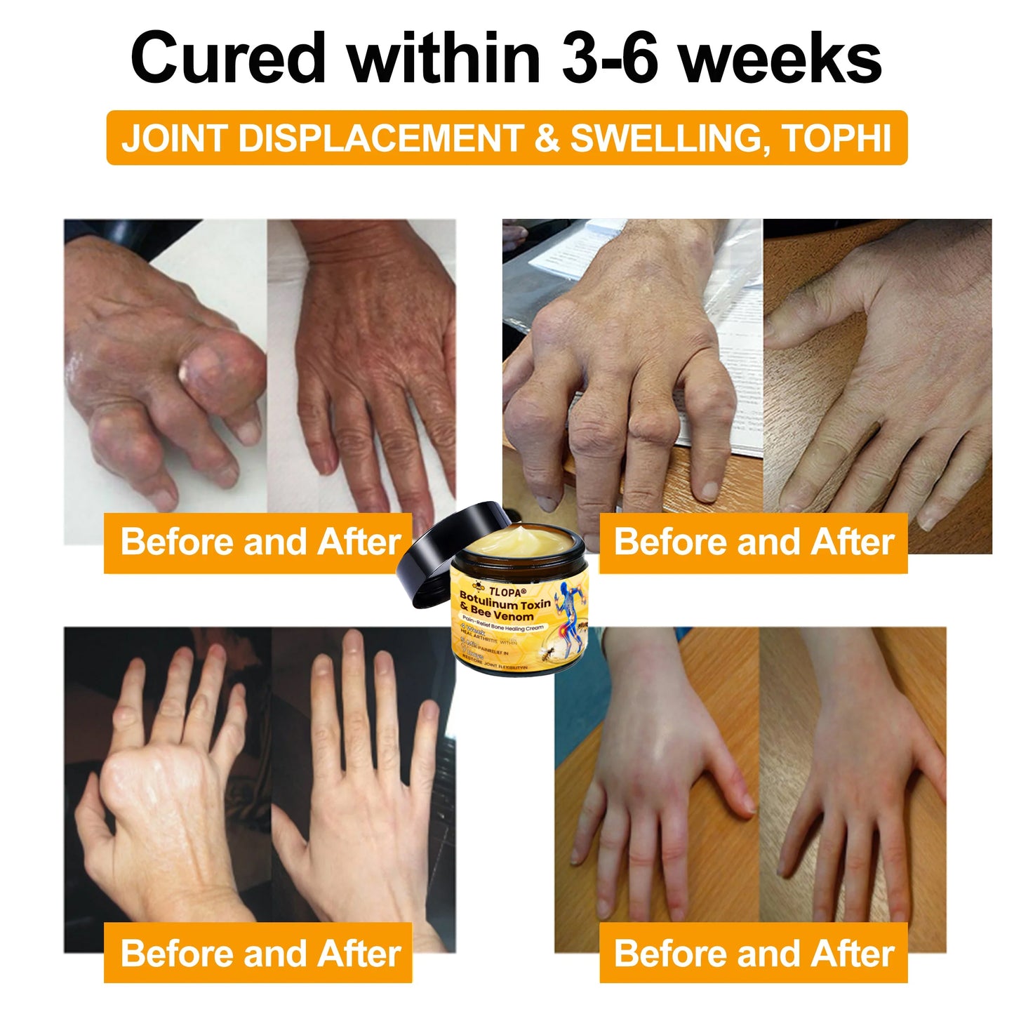 Official Store💎TLOPA® Botulinum Toxin & Bee Venom Pain-Relief Bone Healing Cream💎㊇