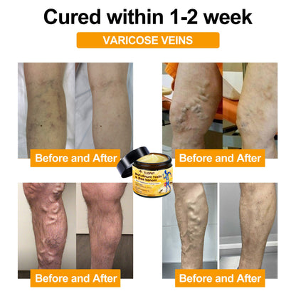 Official Store💎TLOPA® Botulinum Toxin & Bee Venom Pain-Relief Bone Healing Cream💎㊇