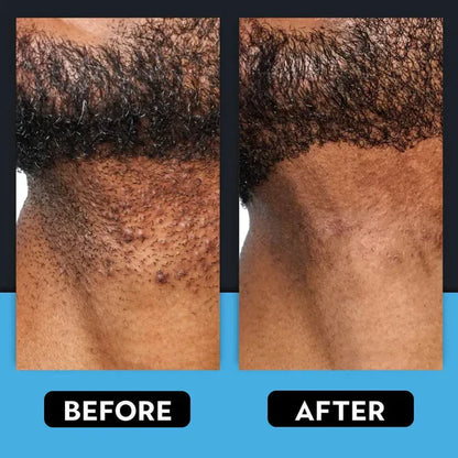 Razor Bump & Ingrown Hair Treatment
